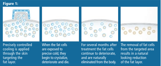 Fat Reduction with Cryolipolysis