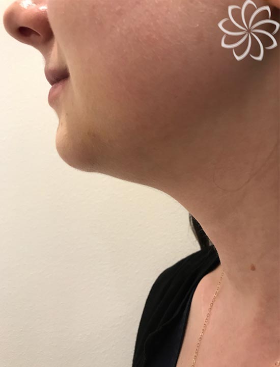 Get Rid of Double Chin